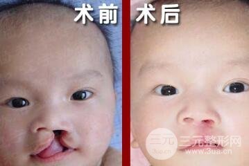 兔唇修复的比较好时间是什么时候？兔唇修复要做几次？