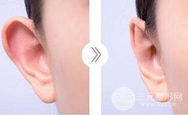 招风耳整形手术多少钱?矫正果图