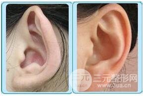 招风耳矫正好不好?会不会留疤?