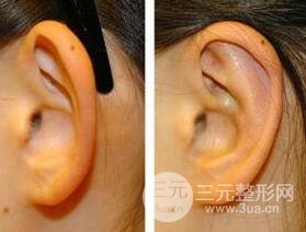 招风耳矫正图片，招风耳矫正整形价格介绍