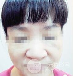 自从打了胶原蛋白除皱以后，都说我年轻多了