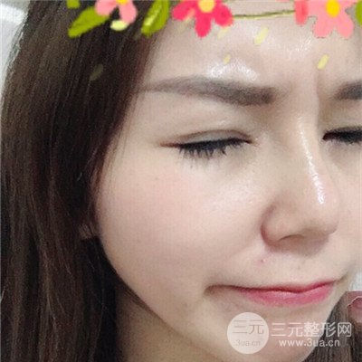 济南曹博士美容医院曹景敏眼部综合整形真人案例分享