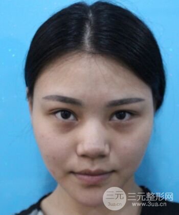 在汉中韩美做了隆鼻整形一个月，恢复越来越自然了