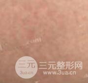 果酸换肤去妊娠纹真人案例和妊娠纹整形手术前后对比图