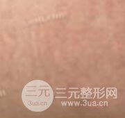 果酸换肤去妊娠纹真人案例和妊娠纹整形手术前后对比图