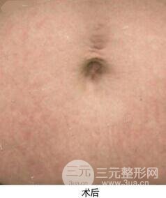 果酸换肤去妊娠纹真人案例和妊娠纹整形手术前后对比图