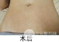 如何去除妊娠纹？做了果酸换肤去妊娠纹果不错，真人案例图片分享