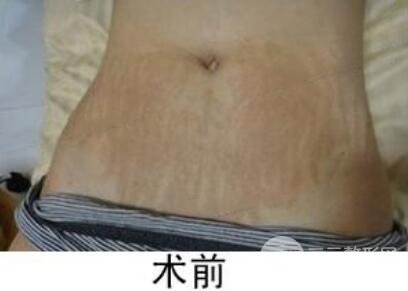 如何去除妊娠纹？做了果酸换肤去妊娠纹果不错，真人案例图片分享