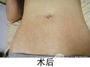 如何去除妊娠纹？做了果酸换肤去妊娠纹果不错，真人案例图片分享