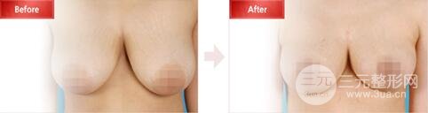 巨大乳房缩小多少钱？成好吗?巨大乳房缩小对比图