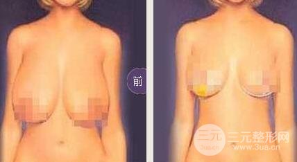 巨大乳房缩小多少钱？成好吗?巨大乳房缩小对比图