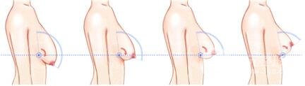 巨大乳房缩小手术后遗症有哪些?多少钱? 巨大乳房缩小果图
