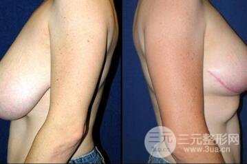 巨大乳房缩小手术后遗症有哪些?多少钱? 巨大乳房缩小果图