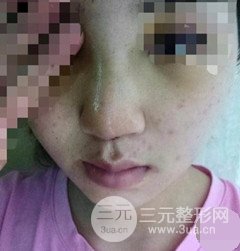 重庆星范丽格手术隆鼻后术后恢复案例图