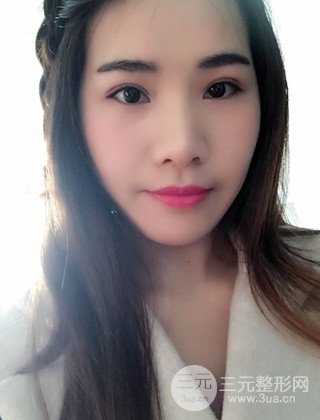 汉中韩美切开双眼皮开眼角恢复对比照片