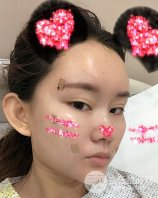 南昌永康自体脂肪面部填充两个半月果图