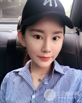 南昌永康自体脂肪面部填充两个半月果图