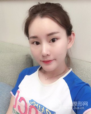 南昌永康自体脂肪面部填充两个半月果图