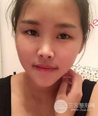 开内眼角割双眼皮案例介绍和恢复过程图