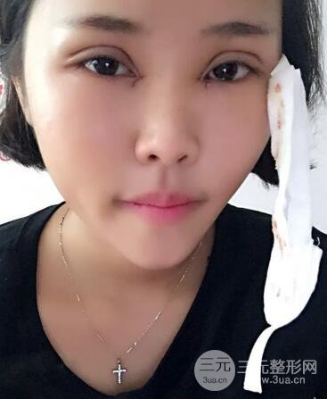 开内眼角割双眼皮案例介绍和恢复过程图