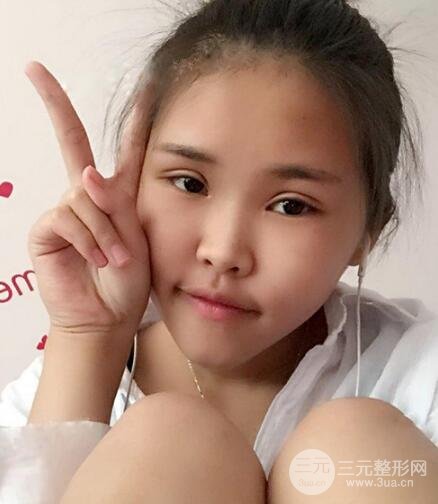 开内眼角割双眼皮案例介绍和恢复过程图