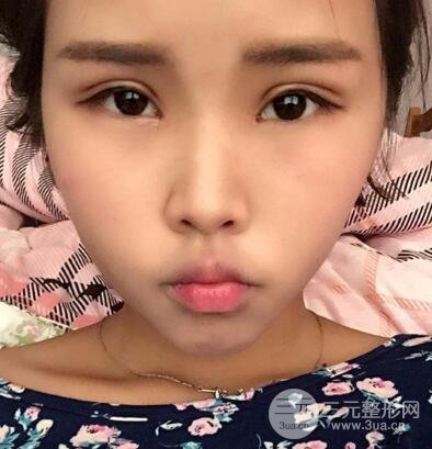 开内眼角割双眼皮案例介绍和恢复过程图