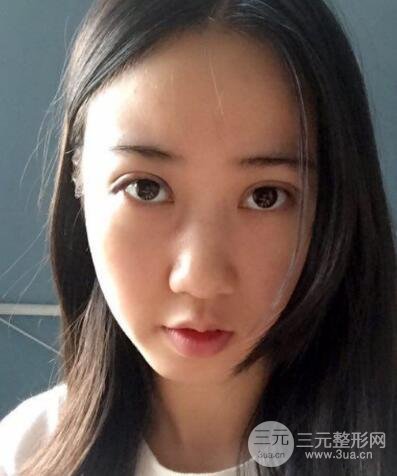 埋线双眼皮真人案例和十天恢复图片日记