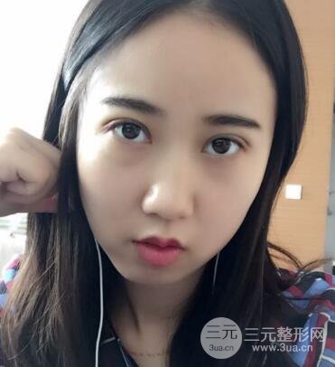 埋线双眼皮真人案例和十天恢复图片日记