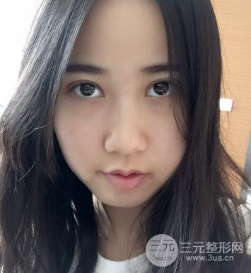 埋线双眼皮真人案例和十天恢复图片日记