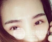 切开双眼皮恢复过程对比图和真人案例 切开双眼皮价格4600元