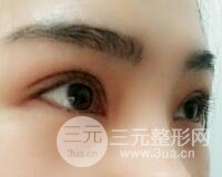 切开双眼皮恢复过程对比图和真人案例 切开双眼皮价格4600元
