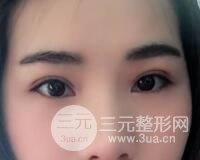 切开双眼皮恢复过程对比图和真人案例 切开双眼皮价格4600元