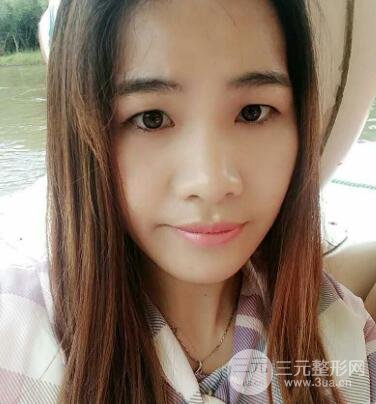 切开双眼皮恢复过程对比图和真人案例 切开双眼皮价格4600元