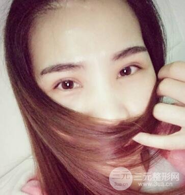 切开双眼皮恢复过程对比图和真人案例 切开双眼皮价格4600元