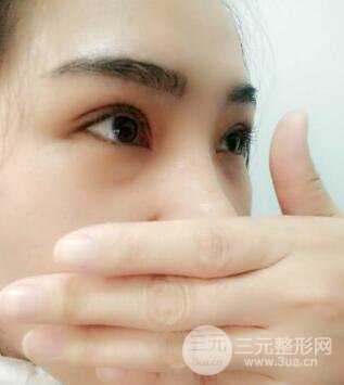 切开双眼皮恢复过程对比图和真人案例 切开双眼皮价格4600元