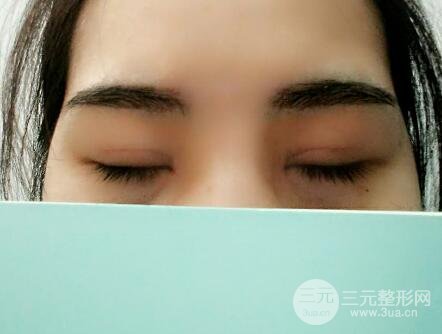 切开双眼皮恢复过程对比图和真人案例 切开双眼皮价格4600元