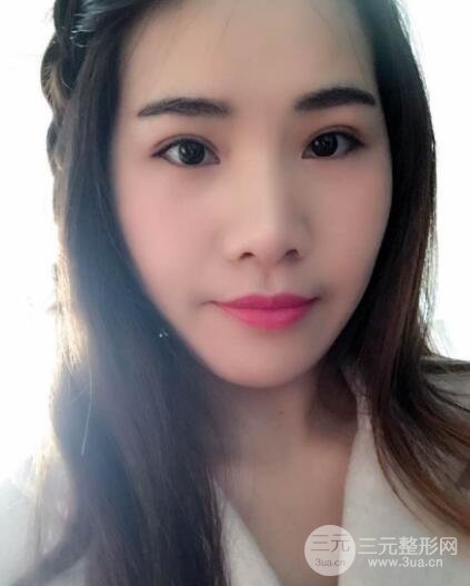 切开双眼皮恢复过程对比图和真人案例 切开双眼皮价格4600元