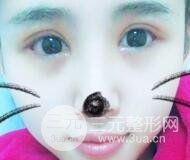 割双眼皮六个月恢复过程图片和真实案例