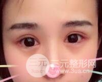 割双眼皮六个月恢复过程图片和真实案例
