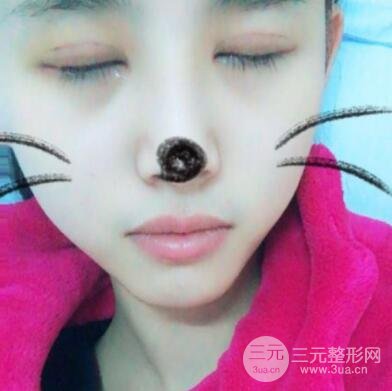 割双眼皮六个月恢复过程图片和真实案例