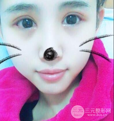 割双眼皮六个月恢复过程图片和真实案例