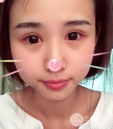 割双眼皮六个月恢复过程图片和真实案例