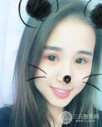 割双眼皮六个月恢复过程图片和真实案例