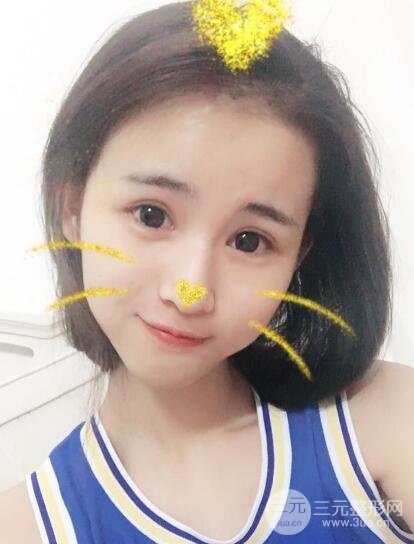 割双眼皮六个月恢复过程图片和真实案例