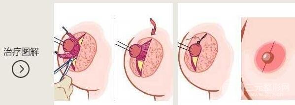 乳头内陷不纠正的后果 乳头内陷矫正术多少钱?