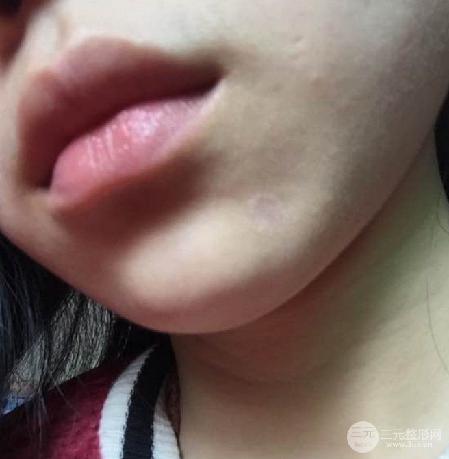 济南曹博士鲁开化激光祛疤真人案例分享