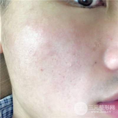 济南曹博士鲁开化祛痘坑痘印真人案例分享