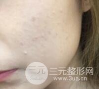 水光补水嫩肤果图前后对比和恢复过程真实案例分享