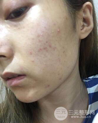 水光补水嫩肤果图前后对比和恢复过程真实案例分享