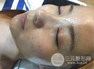 水光补水嫩肤果图前后对比和恢复过程真实案例分享